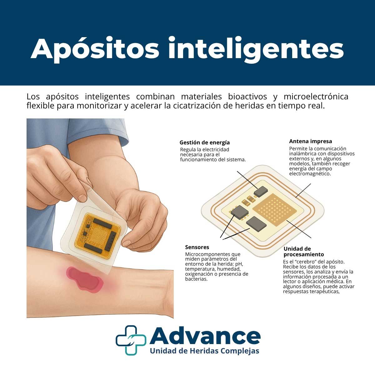 Infografía de apósitos inteligentes para úlceras por presión: sensores, antena impresa, gestión de energía y unidad de procesamiento que monitorizan la herida y aceleran la cicatrización.