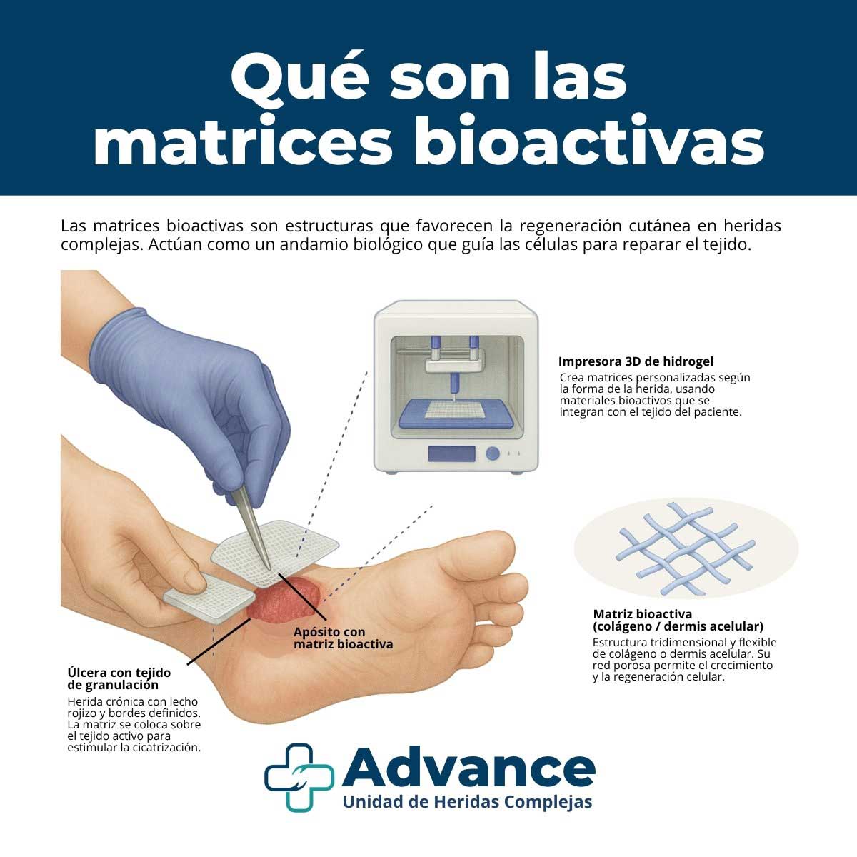 Infografía sobre matrices bioactivas para heridas: andamio biológico de colágeno o dermis acelular, opción de impresión 3D de hidrogel y aplicación sobre úlcera del pie con tejido de granulación.