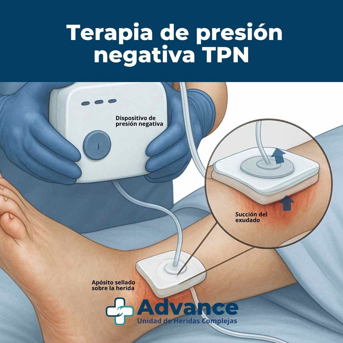 Ilustración médica realista de una enfermera utilizando un dispositivo de presión negativa sobre una herida del pie, con apósito sellado para favorecer la cicatrización.