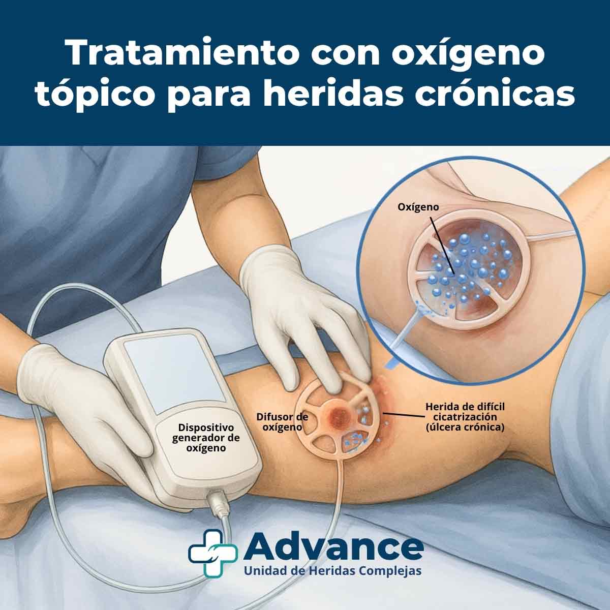 Ilustración médica realista de una enfermera aplicando oxigenoterapia tópica con dispositivo generador y difusor de oxígeno sobre una herida crónica en la pierna.