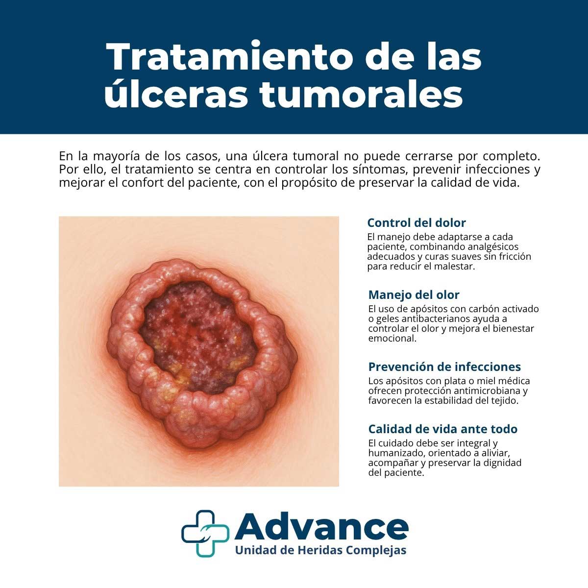 Infografía sobre tratamiento de las úlceras tumorales: control del dolor, manejo del olor (apósitos con carbón o geles antibacterianos), prevención de infecciones y enfoque en calidad de vida.