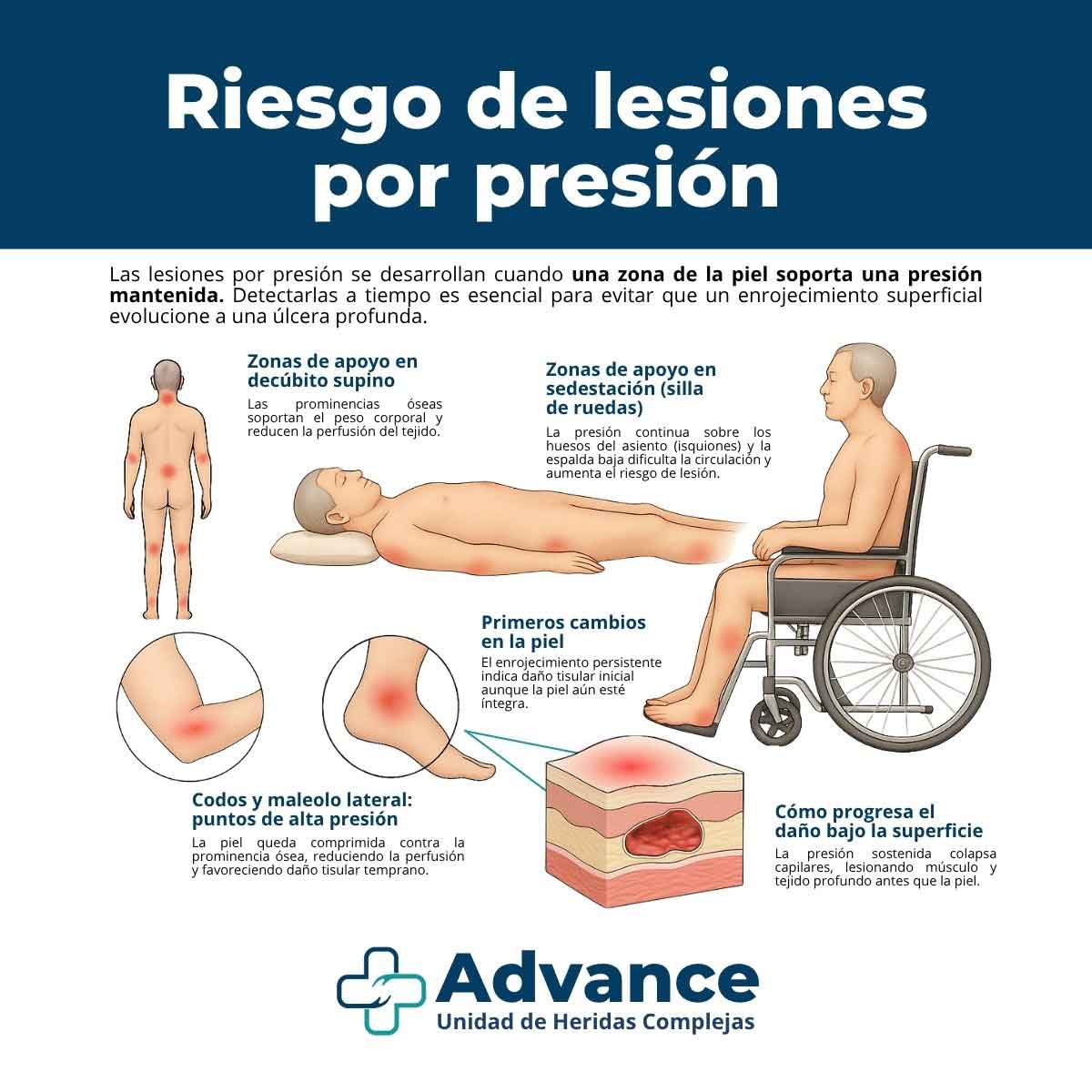 Infografía médica que muestra las principales zonas de riesgo de lesiones por presión en pacientes encamados: talones, sacro, caderas, codos, tobillos y omóplatos. Ilustración clara y didáctica para educación sanitaria.