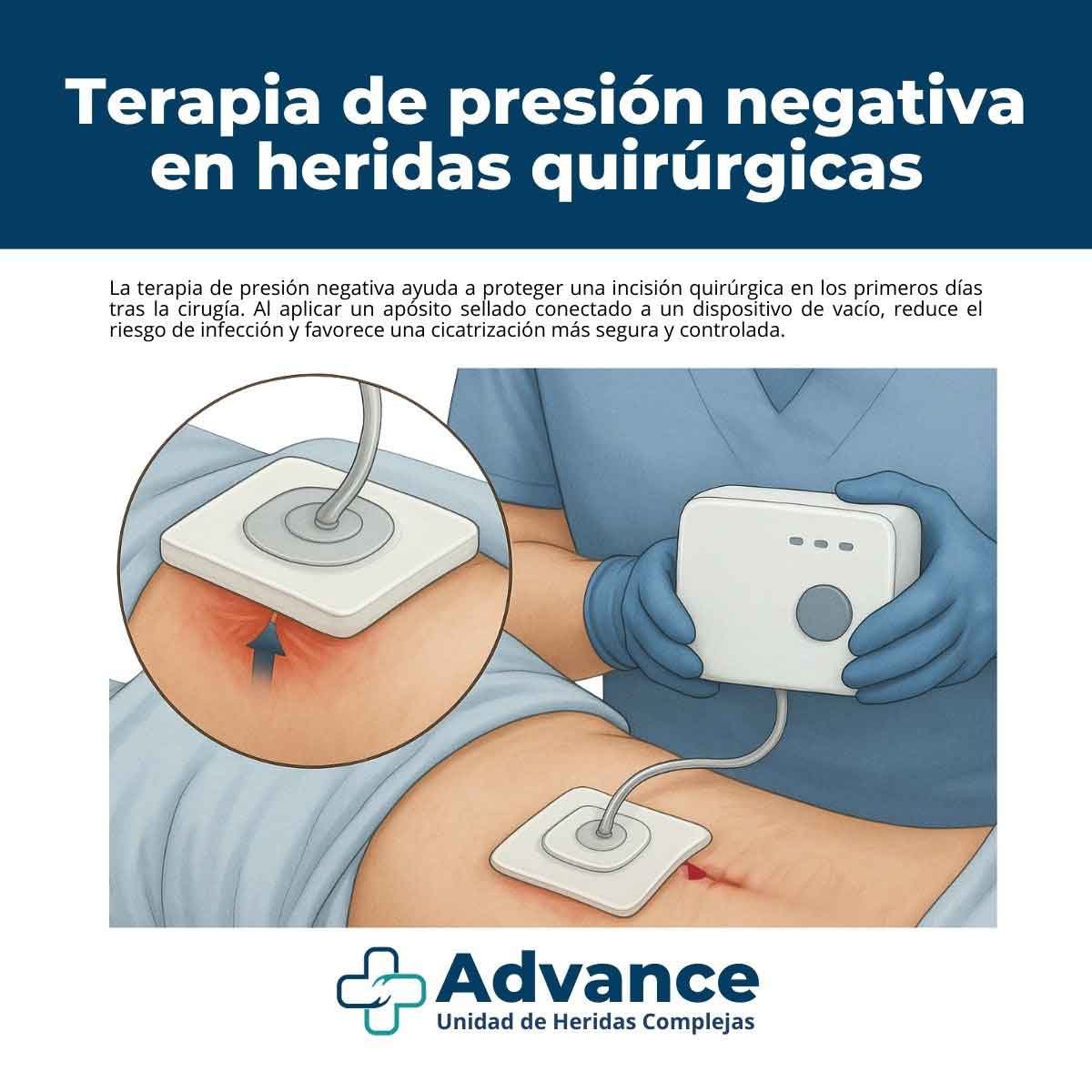 Infografía que explica cómo la presión negativa protege una herida quirúrgica mediante un apósito sellado conectado a un dispositivo de vacío, reduciendo el riesgo de infección.