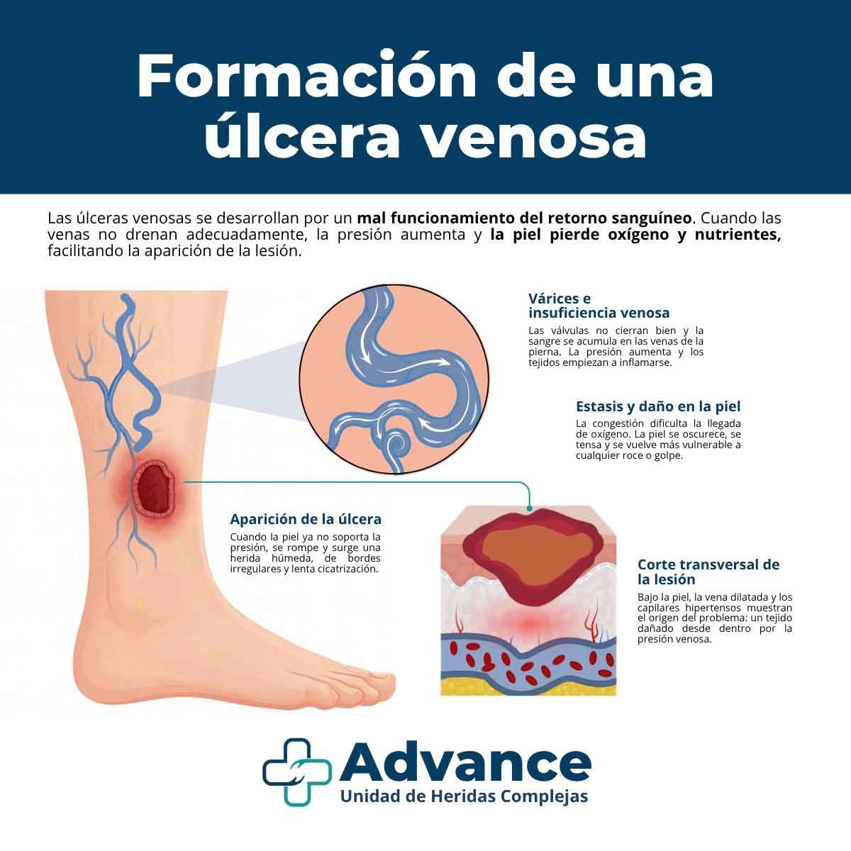 Diferencias entre úlcera venosa y úlcera arterial