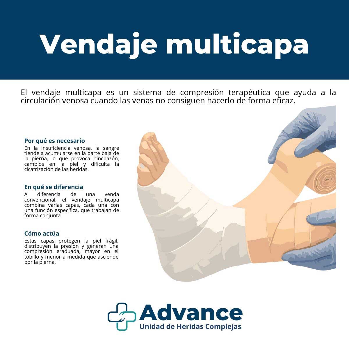 Esquema ilustrado del vendaje multicapa utilizado en compresión terapéutica para mejorar el retorno venoso en la pierna
