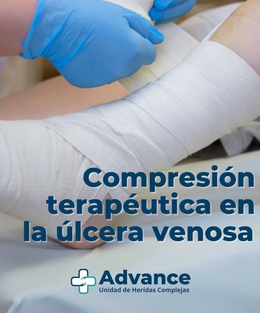 aplicación de vendaje de compresión en pierna como parte del tratamiento de la insuficiencia venosa