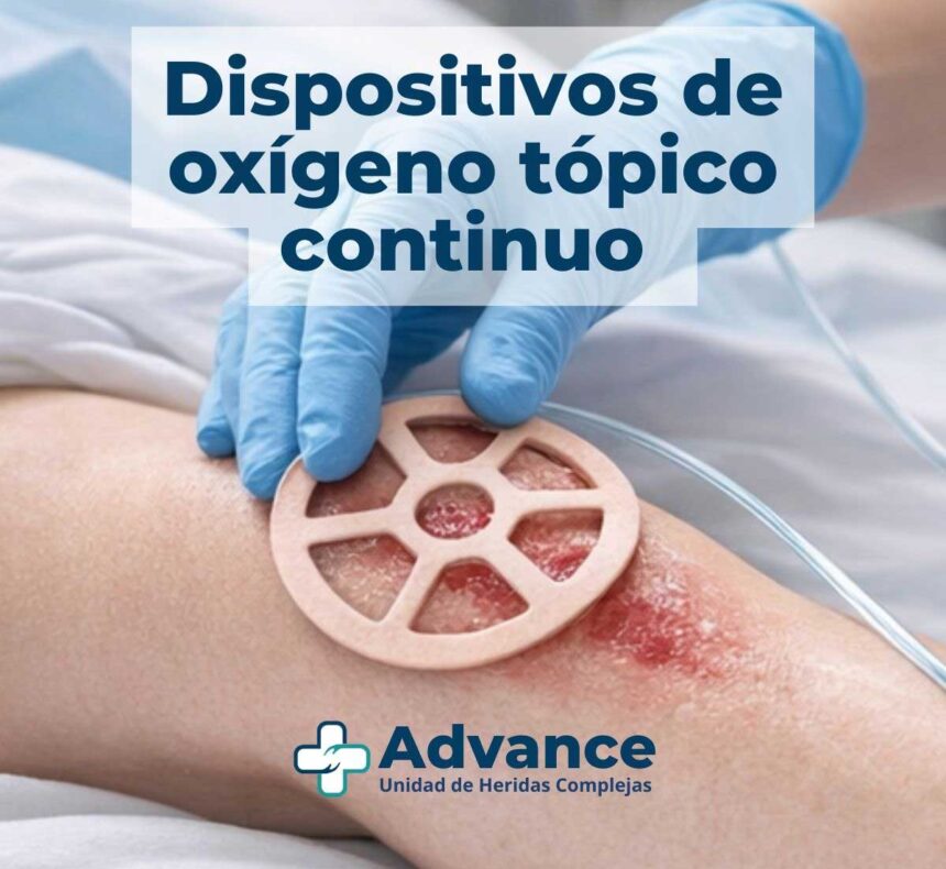 Oxigenoterapia tópica continua aplicada directamente sobre una herida crónica para favorecer la cicatrización.