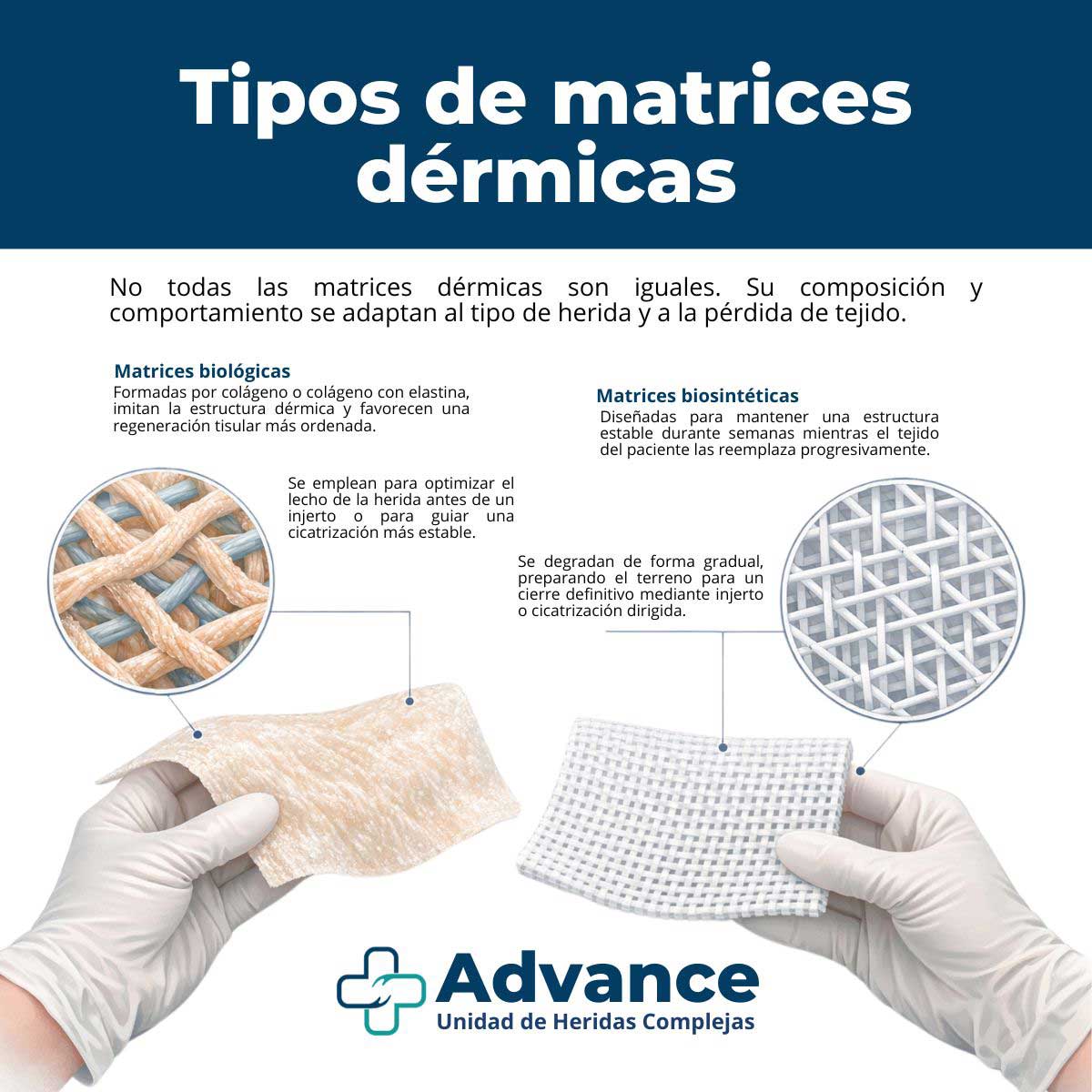 Infografía sobre los tipos de matrices dérmicas utilizadas en heridas traumáticas con pérdida de tejido