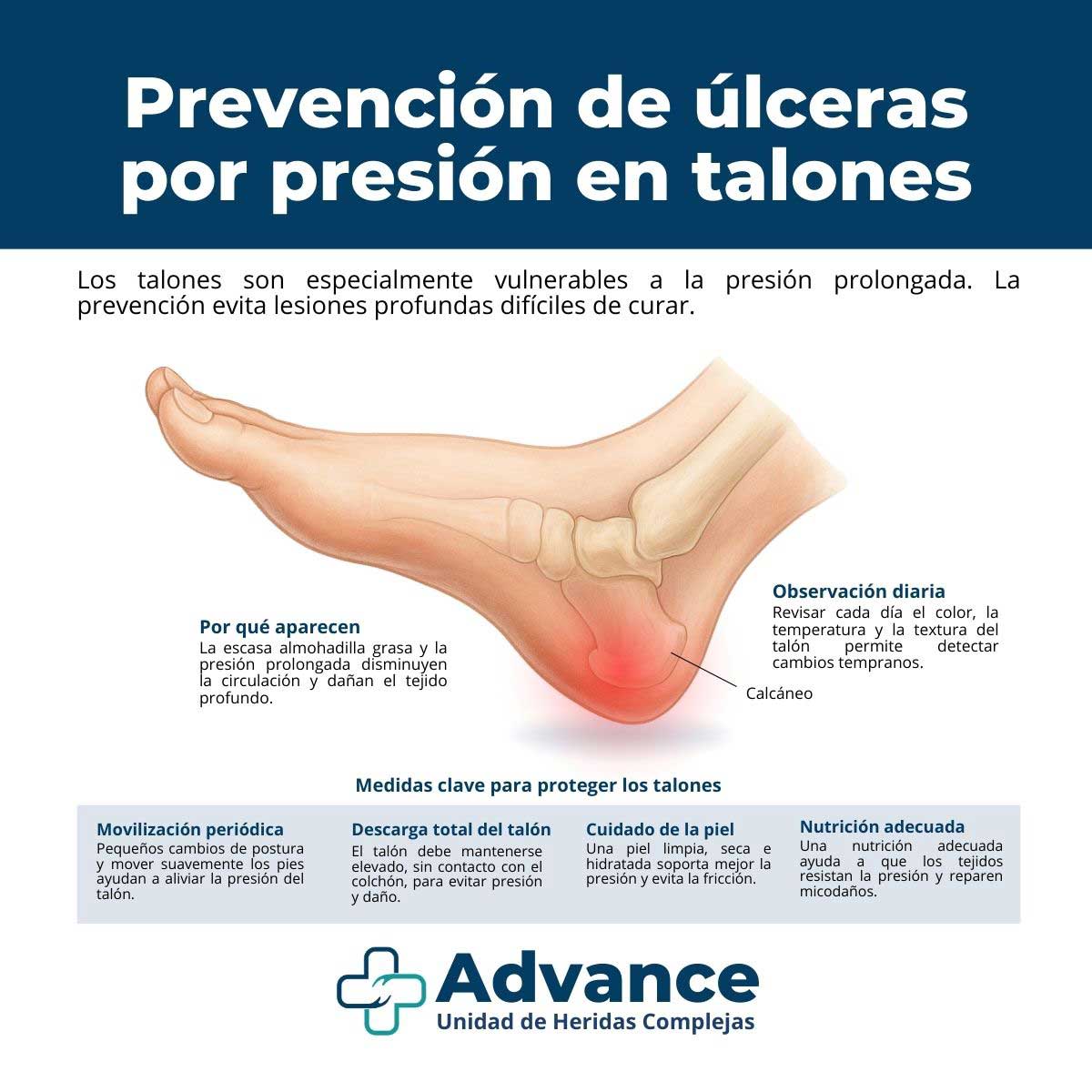 Infografía sobre prevención de úlceras por presión en talones con causas, medidas preventivas y observación diaria.