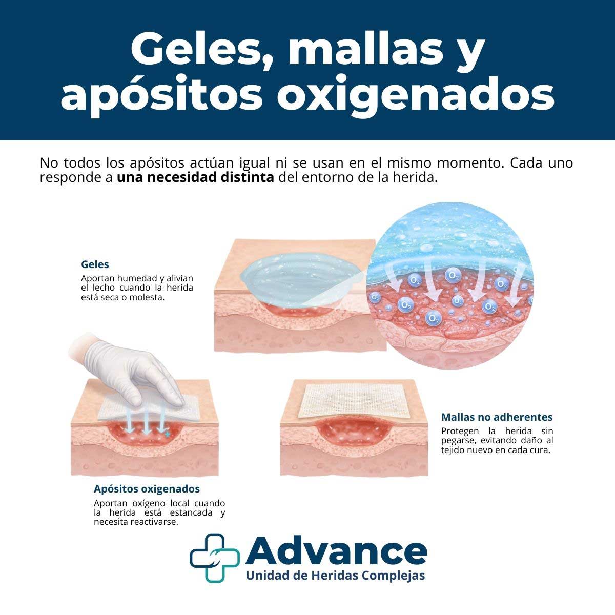 Infografía que explica las diferencias entre geles, mallas no adherentes y apósitos oxigenados en el cuidado de heridas