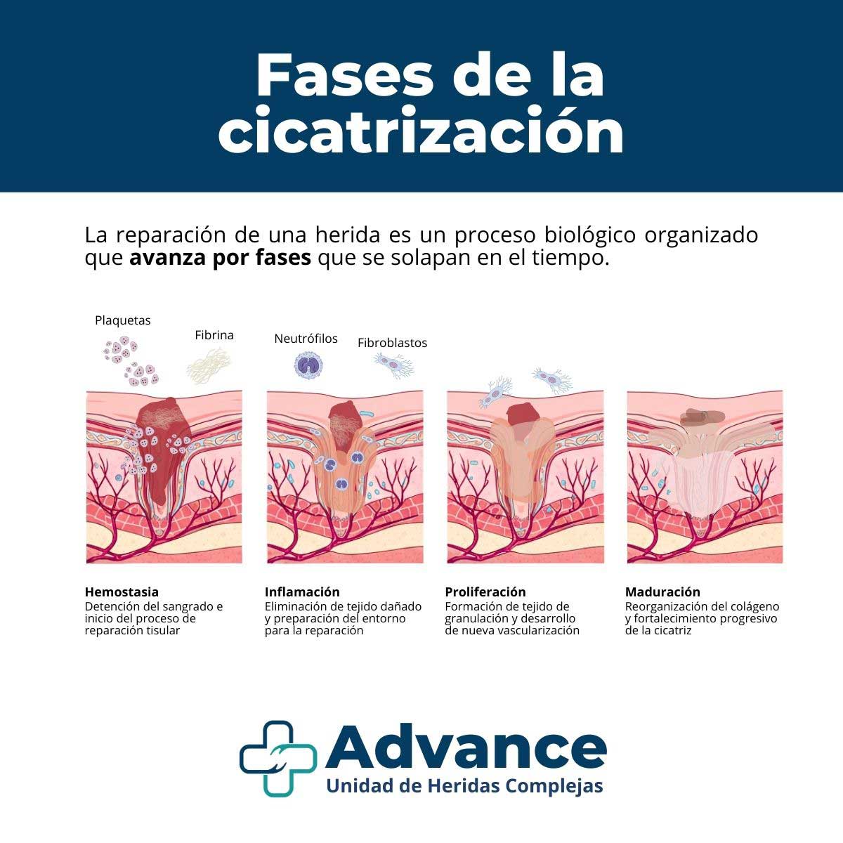 Infografía que muestra las fases de la cicatrización de una herida: hemostasia, inflamación, proliferación y maduración.