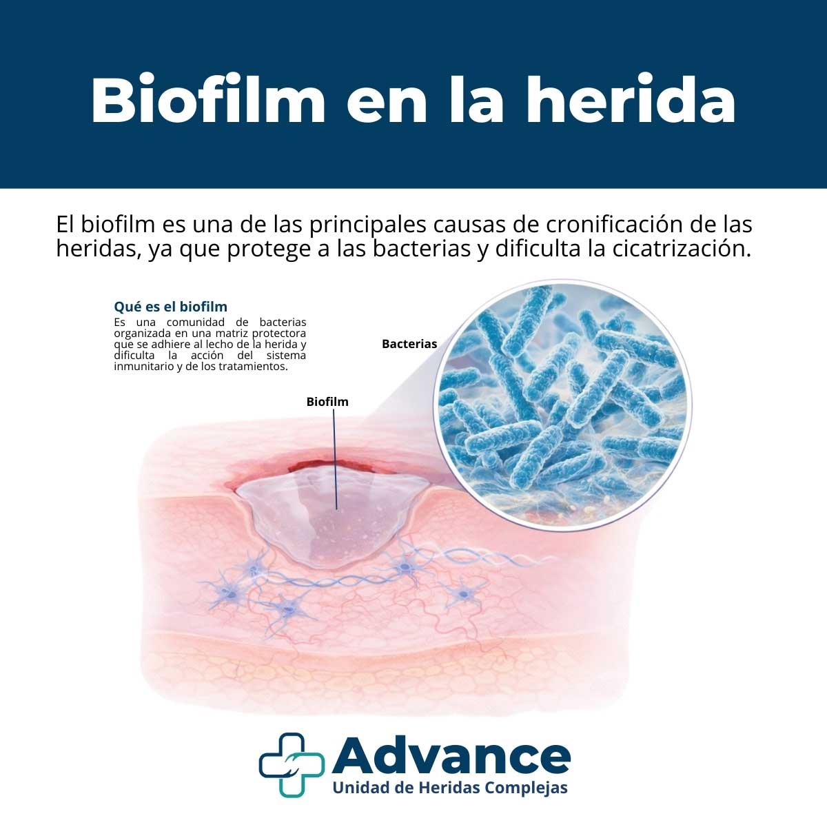 Ilustración médica del biofilm adherido al lecho de una herida con detalle ampliado de bacterias.