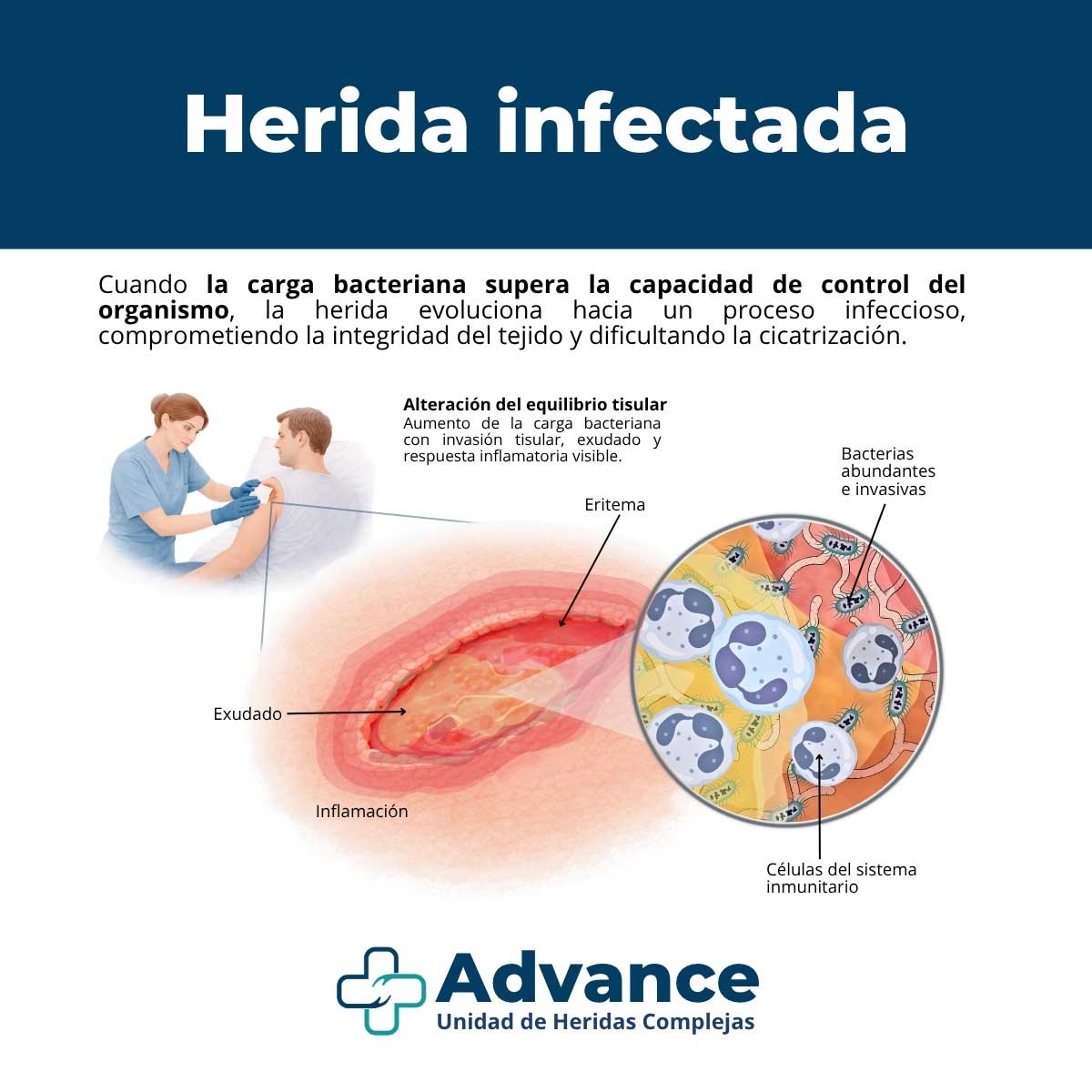 Infografía médica que muestra los signos de infección en una herida y la presencia de bacterias y células defensivas