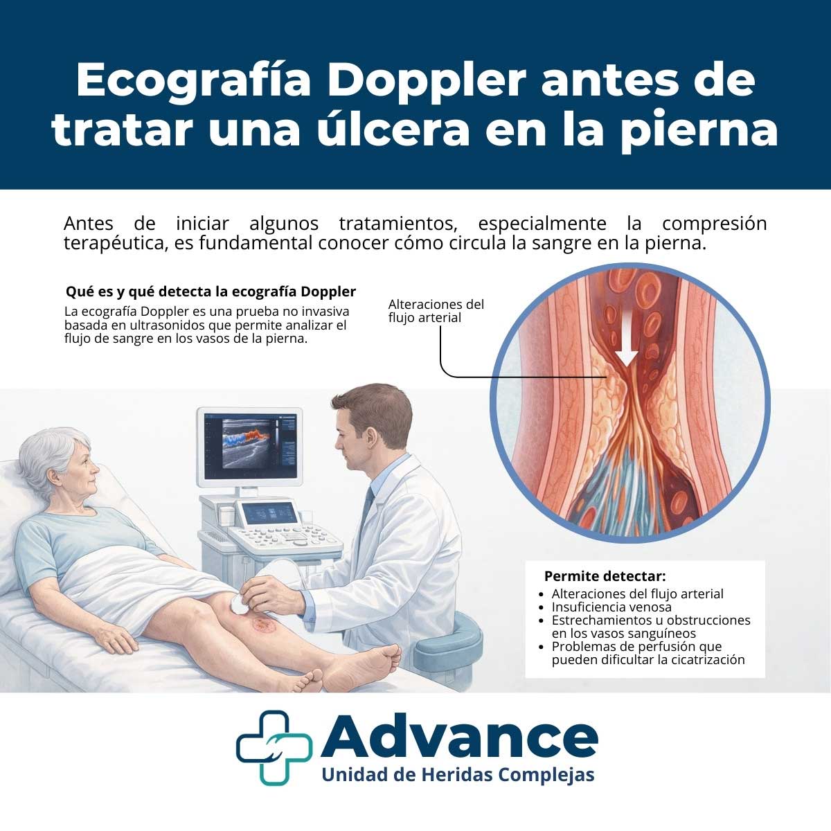 Infografía médica sobre ecografía Doppler para evaluar la circulación antes de tratar una úlcera en la pierna