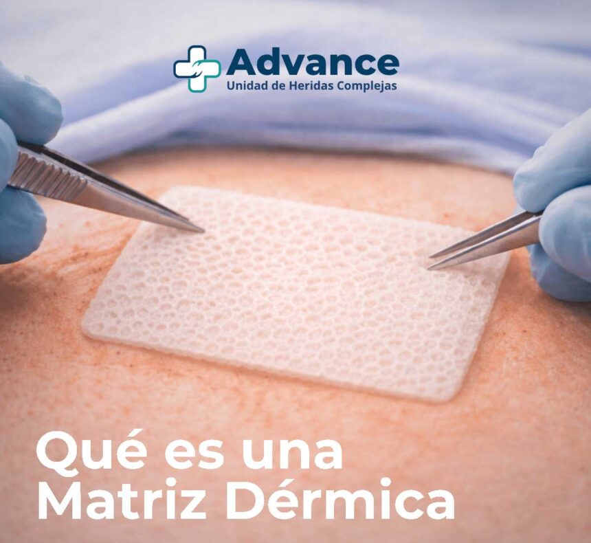 La matriz dérmica se aplica sobre el lecho de la herida para facilitar la regeneración tisular.