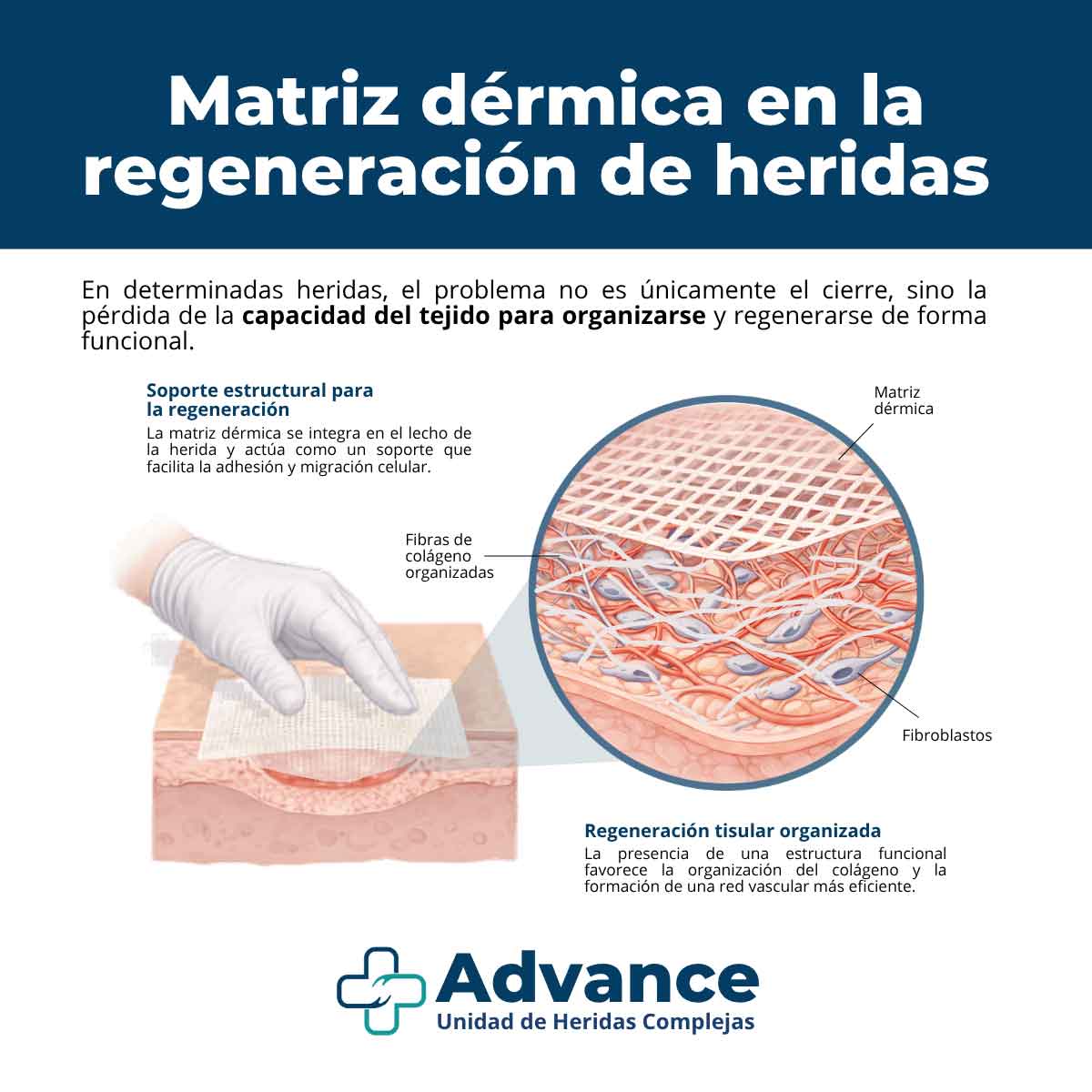 Infografía sobre cómo la matriz dérmica favorece la regeneración del tejido en heridas complejas