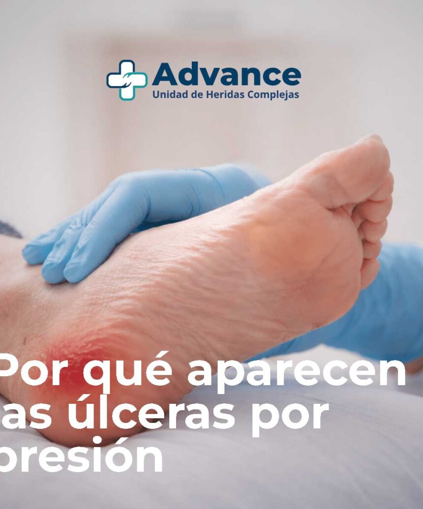 Imagen de una úlcera por presión en el talón en fase inicial con eritema localizado, signo precoz de daño tisular.