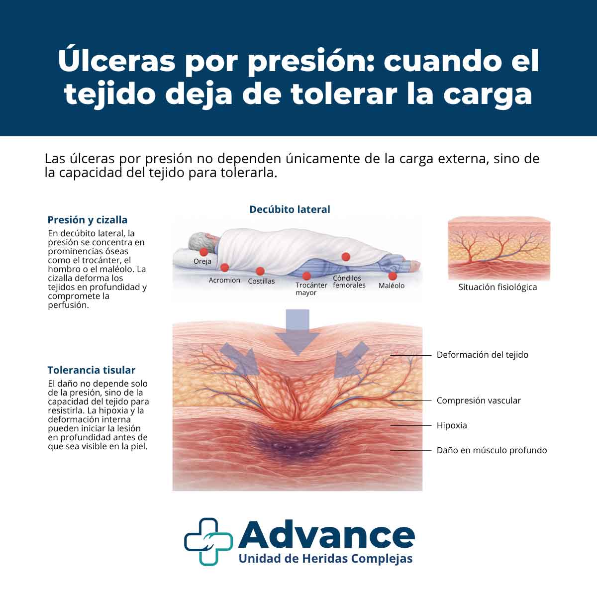 Infografía sobre cómo la presión y la cizalla provocan daño tisular en úlceras por presión