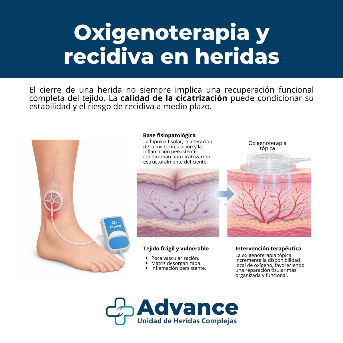 Infografía sobre oxigenoterapia tópica en heridas crónicas y su impacto en la prevención de recidivas