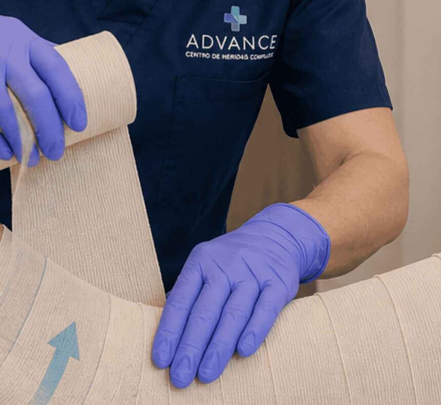 Aplicación de terapia compresiva en una úlcera venosa para mejorar el retorno venoso y favorecer la cicatrización.