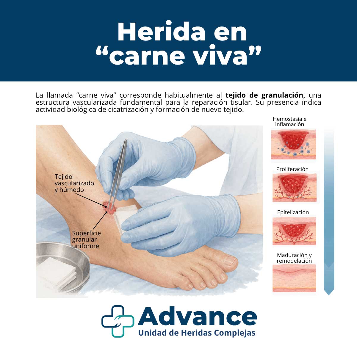 Infografía médica sobre herida en carne viva y tejido de granulación durante la cicatrización.