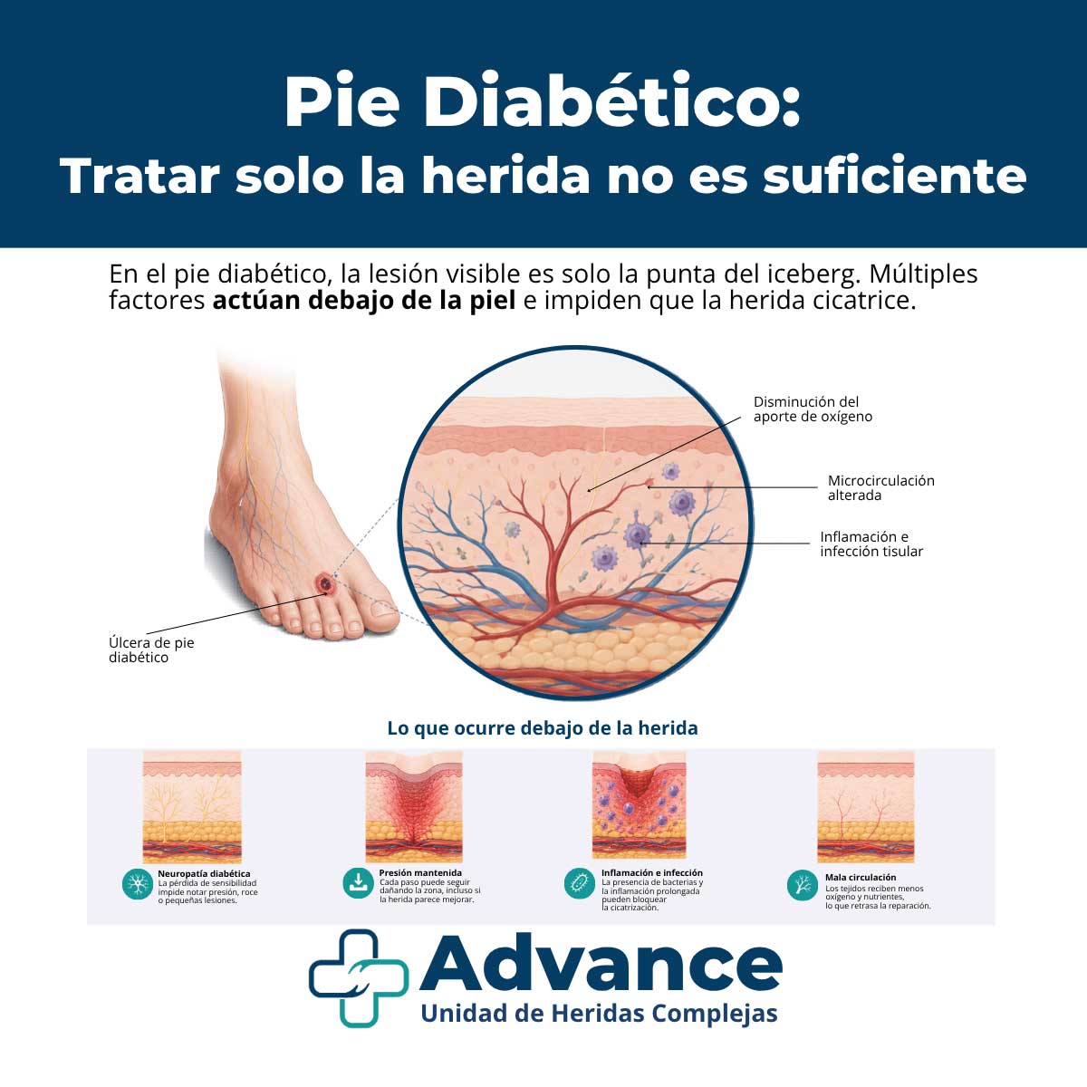 pie diabético, herida pie diabético, úlcera pie diabético, cicatrización pie diabético, neuropatía diabética, heridas crónicas, heridas complejas, cuidado de heridas, curas pie diabético, infección pie diabético, presión plantar, descarga de presiones, mala circulación, enfermedad vascular, isquemia, osteomielitis, exudado en heridas, abordaje integral pie diabético, enfermería de heridas, podología, cirugía vascular, control glucémico, prevención de recaídas, úlcera recurrente, valoración especializada, heridas que no cicatrizan