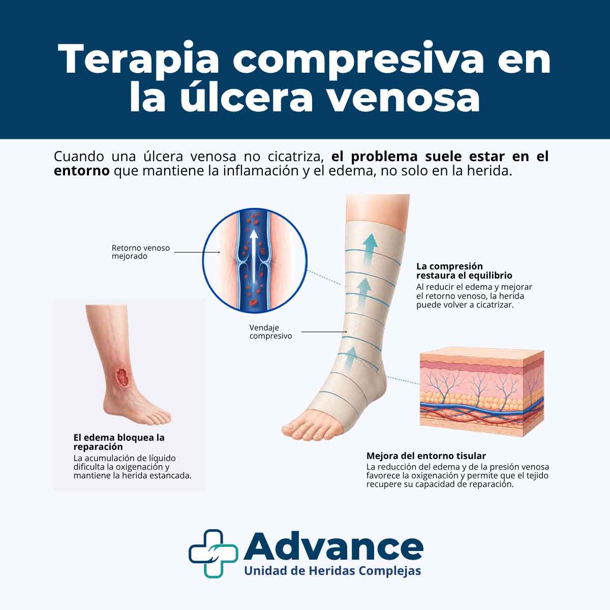 Infografía médica sobre cómo la terapia compresiva mejora el retorno venoso y favorece la cicatrización de la úlcera venosa.