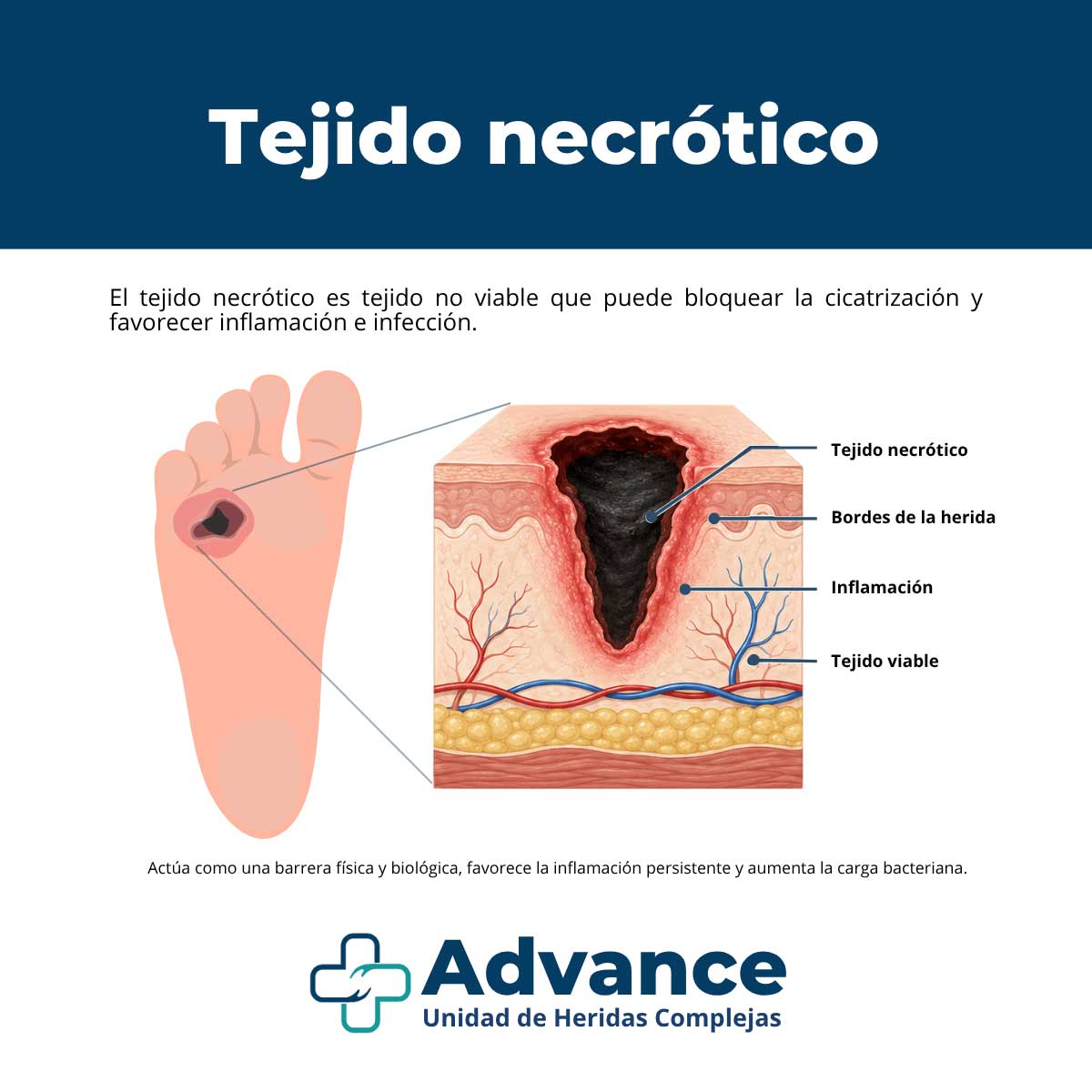 Infografía médica sobre tejido necrótico en una herida, con ilustración de una úlcera en el pie y corte transversal del tejido.