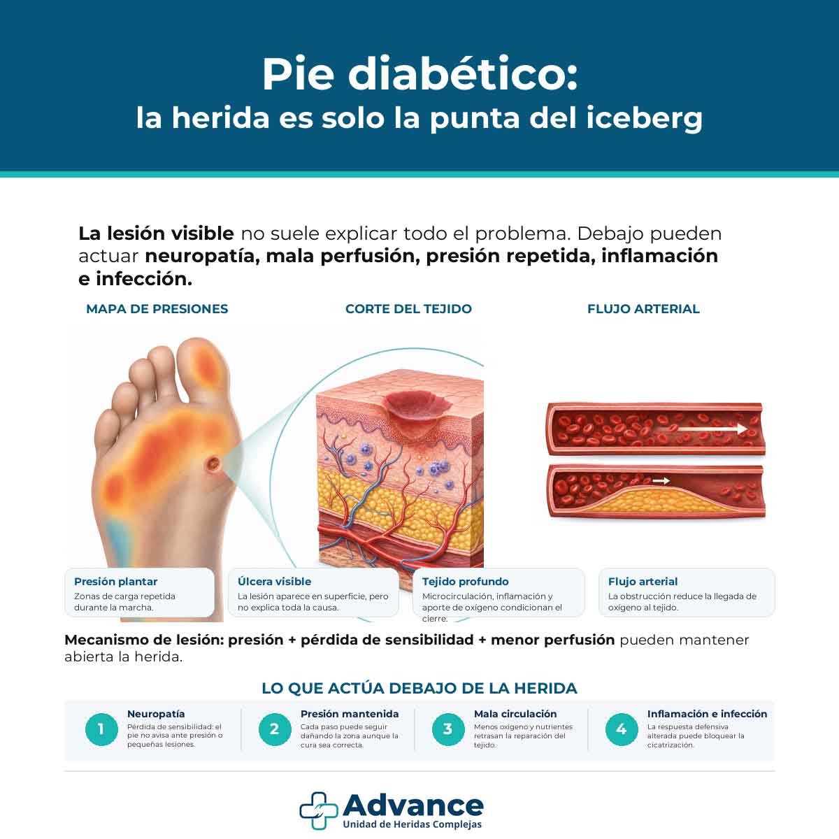 Infografía científica sobre pie diabético con mapa de presiones, corte del tejido y flujo arterial.
